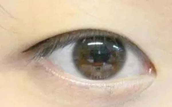徐占峰醫(yī)師在深圳鵬愛醫(yī)院進行雙眼皮手術的效果如何？