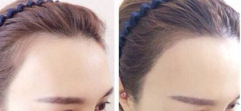 杭州疤痕整形哪家醫(yī)院好？選擇哪個(gè)醫(yī)院更靠譜？