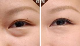 沈陽哪家醫(yī)院做脂肪隆胸效果好且價格合理？