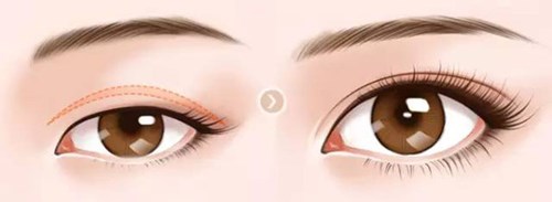 武漢美立方的胡江偉如何進(jìn)行雙眼皮手術(shù)？