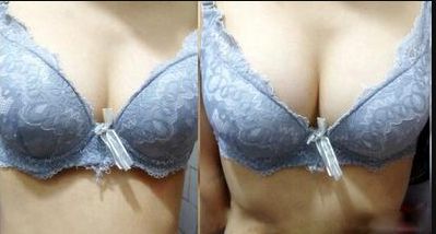廣州哪家醫(yī)院的乳頭凹陷術(shù)效果好？