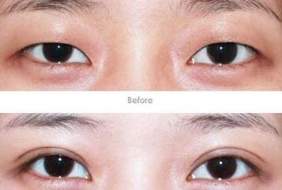 杭州開眼角醫(yī)生哪家好？專家推薦的杭州開眼角醫(yī)院排行榜
