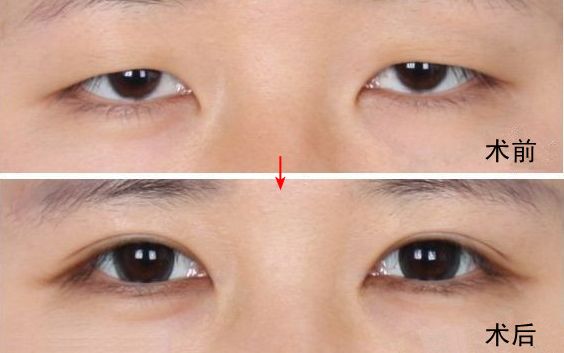 南京哪家醫(yī)院去眼袋好？眼袋手術(shù)選哪家醫(yī)院最好