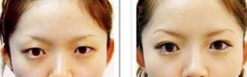 深圳眼袋手術哪家醫(yī)院最靠譜？