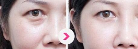 北京哪位醫(yī)生擅長巨乳縮小手術(shù)？5名實(shí)力醫(yī)生值得推薦