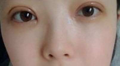 上海哪家醫(yī)院的雙眼皮手術(shù)效果最好？