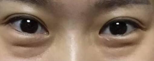 蘇薇潔與楊亞益哪位更適合做雙眼皮？上海美眼大咖實力測評揭曉，你怎么決策？