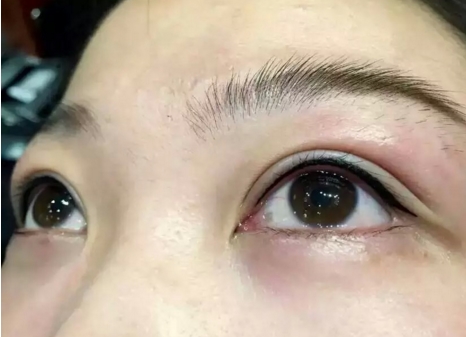 朱石江下頜角整形手術(shù)效果怎么樣？專家解讀+真實(shí)案例分享