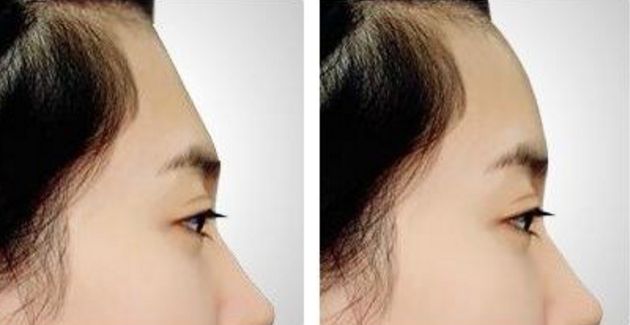 南京割雙眼皮哪家醫(yī)院效果好？