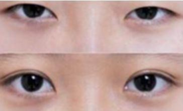秦皇島雙眼皮哪家做的好？選擇前必看！