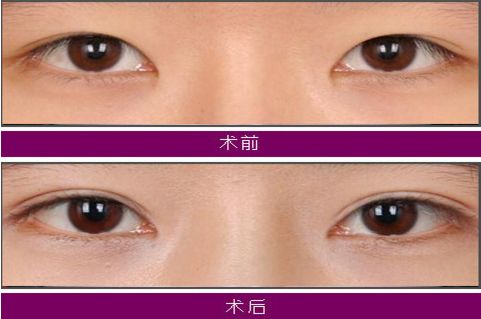 大連注射玻尿酸哪家醫(yī)院技術(shù)好，效果持久？