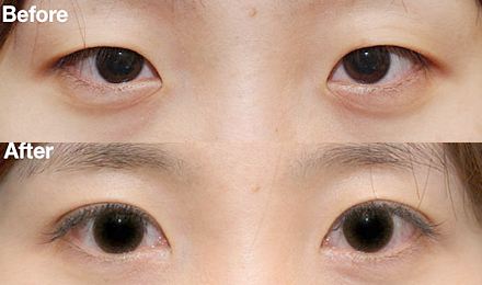 2023深圳黃金微針去除口周紋醫(yī)生綜合實力排行榜(鄭瑜璠、吳曉玲、劉彤大勢醫(yī)美重磅來襲)