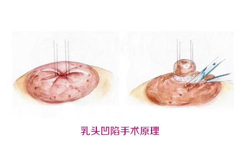 揭秘北京大學(xué)深圳醫(yī)院整形外科名醫(yī)團(tuán)隊(duì)！想了解吸脂案例嗎？來(lái)看這里！