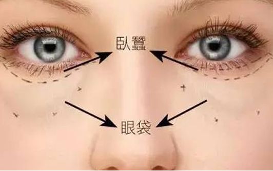 ?？谀募裔t(yī)院做眼袋效果好？