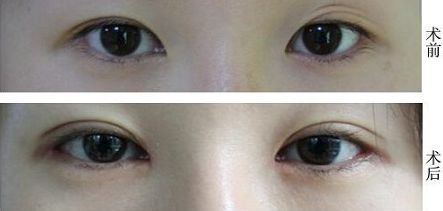 福州抽脂大腿哪家醫(yī)院好？挑選福州最靠譜的抽脂醫(yī)院有哪些？