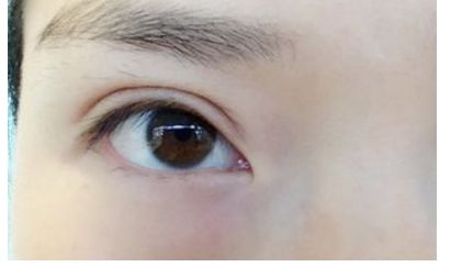 南昌祛痘哪家醫(yī)院口碑好，效果最佳？