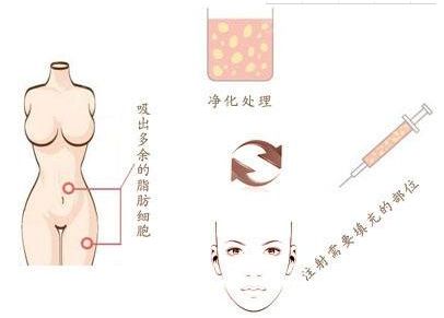 廣州燒傷疤痕治療哪家醫(yī)院效果好，選擇哪家醫(yī)院最靠譜？