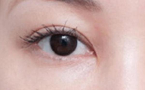 廣州哪家醫(yī)院做隆胸手術(shù)技術(shù)高？醫(yī)生資深經(jīng)驗來看詳細介紹！