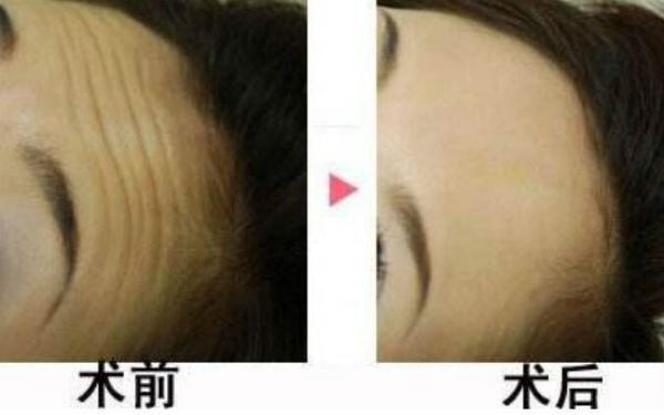 何晉龍的鼻型經(jīng)歷：立體挺拔，妥妥側(cè)顏殺！