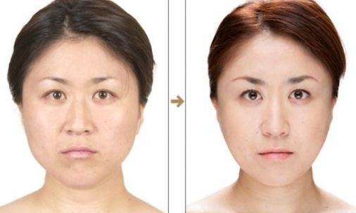 杭州整形醫(yī)院的抽脂效果如何？哪家醫(yī)院抽脂好？
