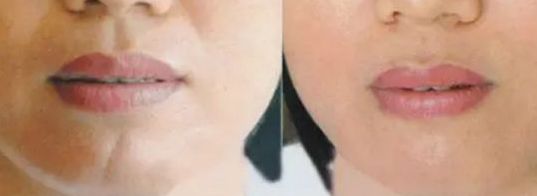 上海面部除疤效果最好的醫(yī)院有哪些？