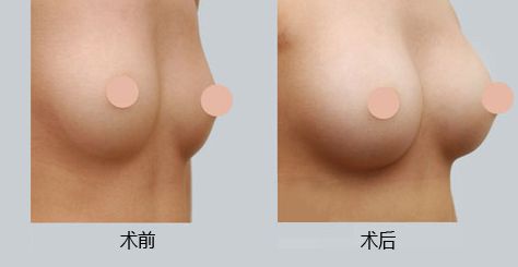 西安墊鼻梁技術(shù)好的醫(yī)院有哪些？
