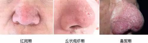 解密楊杰雙眼皮修復失敗案例圖，讓你心中的期望成為現(xiàn)實！