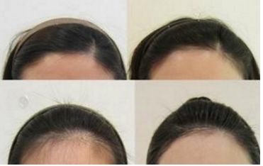 哈爾濱皮秒手術(shù)哪家醫(yī)院好？全面評(píng)測(cè)哈爾濱皮秒醫(yī)院排名