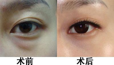 上海天壇普華醫(yī)院優(yōu)秀拉皮專家解析，手術(shù)費(fèi)用清單附中