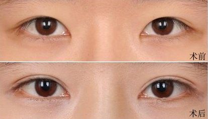 大連假體隆鼻哪家醫(yī)院好？打造完美鼻型，這家醫(yī)院是最佳選擇！