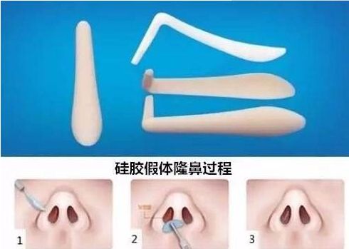 北京哪家醫(yī)院祛除眼袋效果最好？
