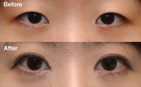 杭州雙眼皮醫(yī)院排名Top1，哪家醫(yī)院做雙眼皮效果好？