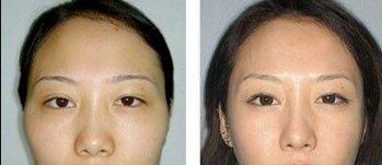 重慶去眼袋哪家醫(yī)院好？選擇靠譜的醫(yī)療機構(gòu)，功效更可靠！