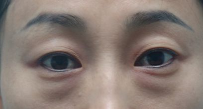 天津醫(yī)院去疤膏效果好的有哪些？