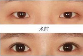 昆明哪家醫(yī)院做熱瑪吉好？挑選昆明熱瑪吉治療專業(yè)的醫(yī)院指南