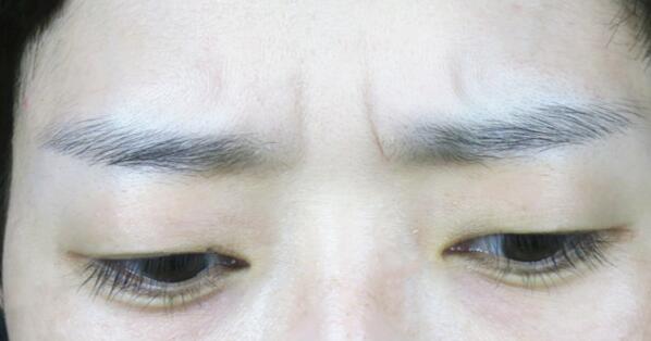 林沸騰整形醫(yī)院福州隆胸手術效果評價