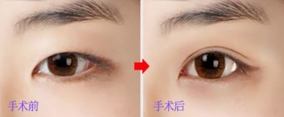 上海玻尿酸豐唇哪家醫(yī)院好？挑選上?？诒玫牟Ｄ蛩嶝S唇醫(yī)院