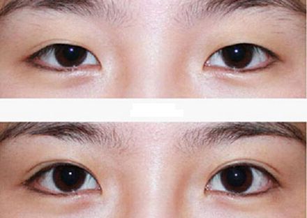 【2023年蘭州歪脖子手術(shù)哪家好？專家推薦+真實(shí)案例分析】