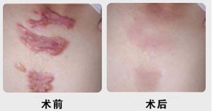 昆明有沒(méi)有哪家專業(yè)祛痘醫(yī)院值得推薦？
