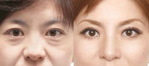 成都做乳暈漂紅哪家好？乳暈漂紅的價(jià)格、效果、方法哪種最合適？