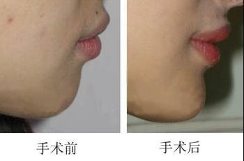 昆明哪家醫(yī)院做上臉下垂手術(shù)好，醫(yī)生技術(shù)靠譜？