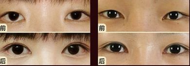 嘟嘟唇無錫哪家醫(yī)院好？專家推薦無錫哪家醫(yī)院治療嘟嘟唇好
