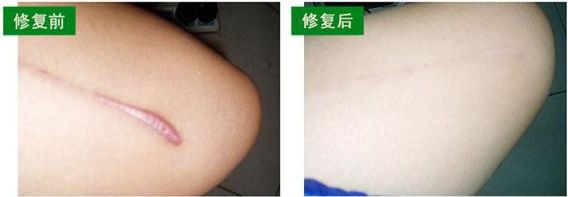 上海微創(chuàng)除皺哪家醫(yī)院好？了解上海微創(chuàng)除皺治療的專業(yè)醫(yī)院推薦