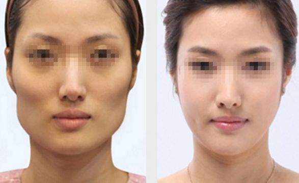 長春雙眼皮修復好的醫(yī)院有哪些？
