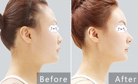 貴陽治療痘坑哪家醫(yī)院專業(yè)可靠？