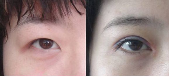 上海市激光修復(fù)痘坑效果如何？哪家醫(yī)院技術(shù)更好？