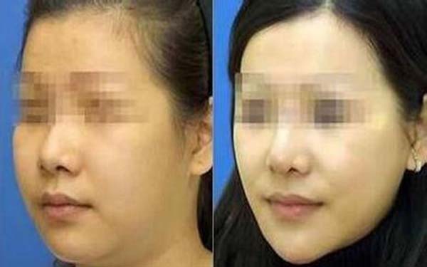 杭州華山整形醫(yī)院陳敬武隆鼻修復效果如何評價