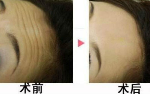 揭秘北京隆鼻領(lǐng)域的專家陳育哲、連凱峰等五位口碑扎實的權(quán)威專家