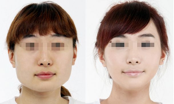 合肥哪家醫(yī)院豐胸效果好，專業(yè)的豐胸醫(yī)院推薦