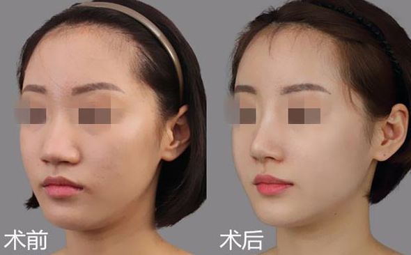 注射瘦臉除皺前需要了解的相關(guān)知識(shí)